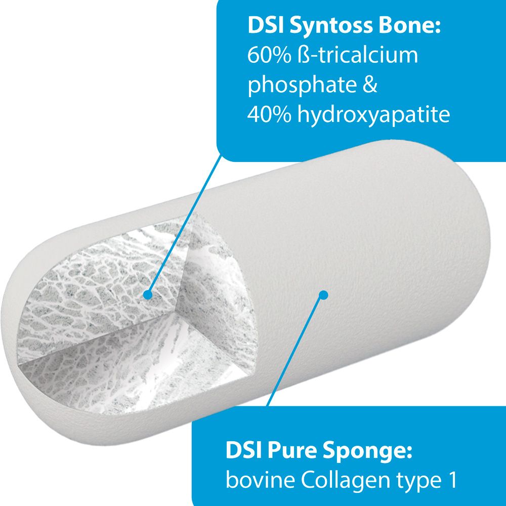 SpongeGraft Bone Plugs for Socket Ridge Grafting Ø10mm L20mm