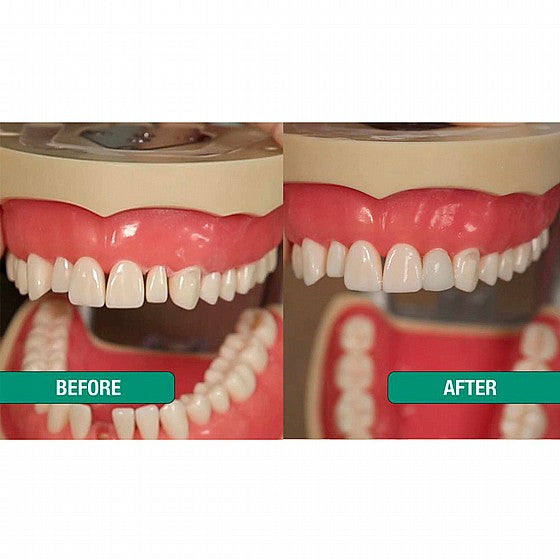 ContacEZ Strips 8PCS For Veneers